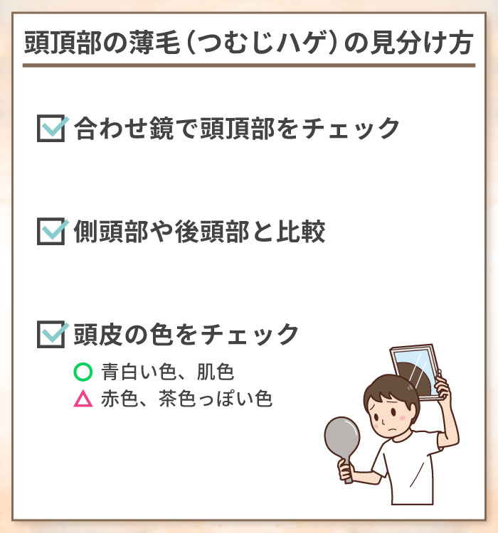 頭頂部の薄毛（つむじはげ）の見分け方