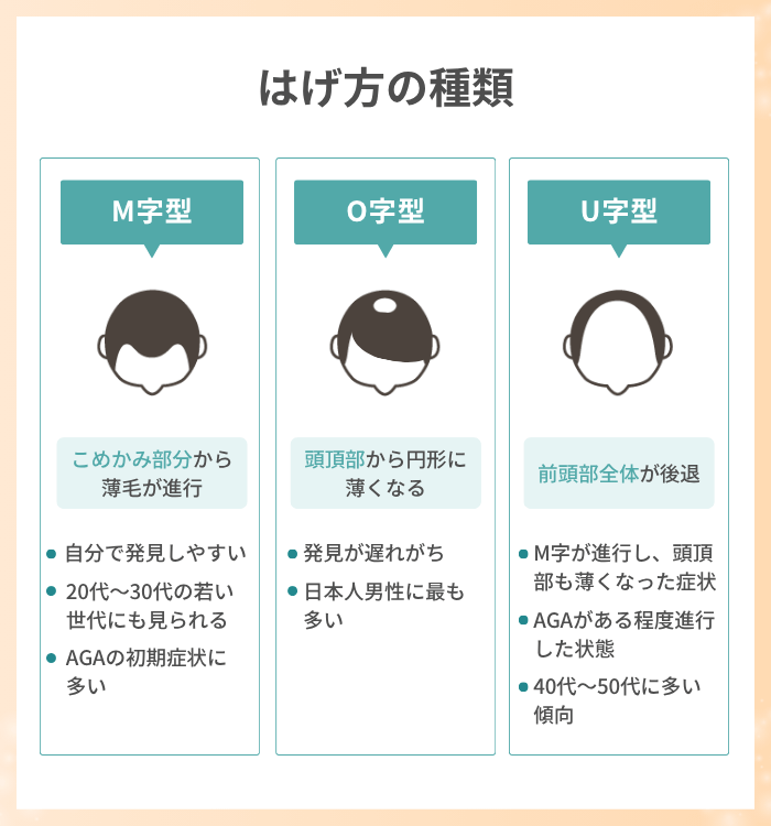 はげ方の種類はM字・O字・U字型！原因と対策方法を解説