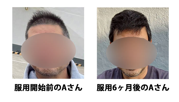 服用開始前と服用6ヶ月後のAさん